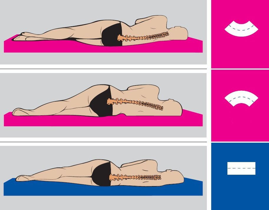 Corretta posizione del corpo durante il sonno con osteocondrosi lombare