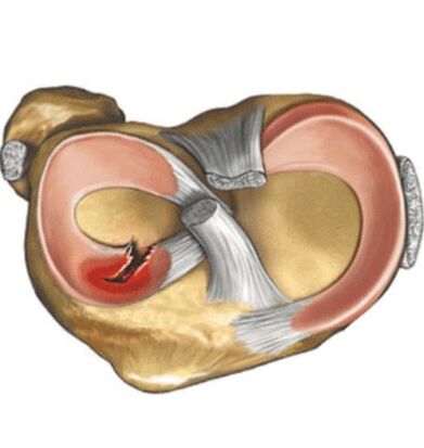 Lesioni menisc