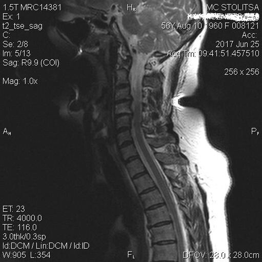Osteocondrosi e spondilosi della colonna cervicale