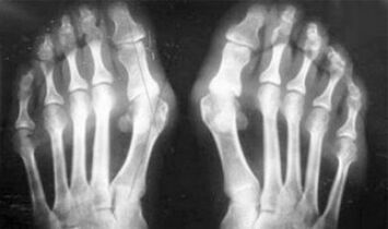 Diagnosi differenziale dei sintomi di artrite e artrosi