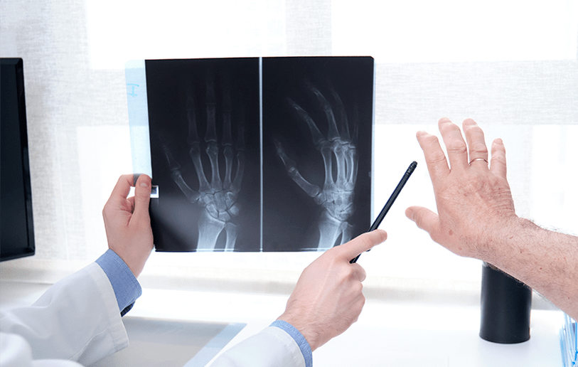 diagnosi di artrosi articolare