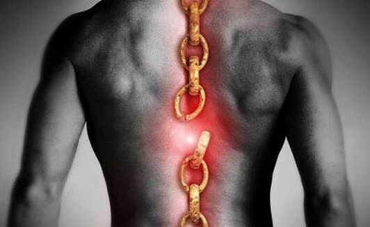 Osteocondrosi della regione toracica